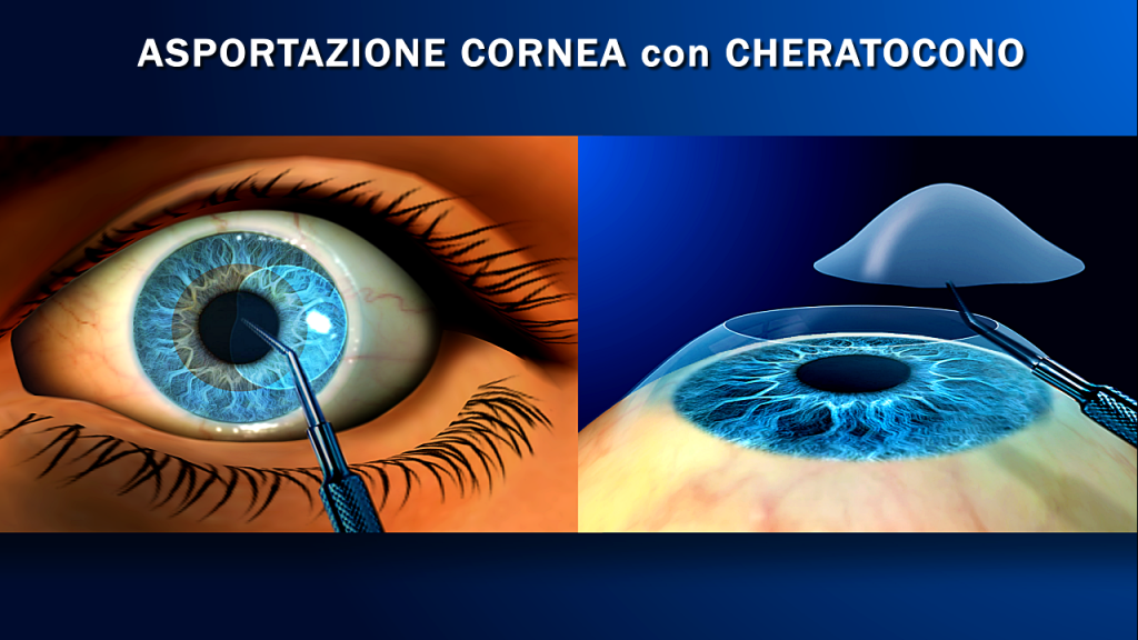 Trapianto Di Cornea Oculisticatv 